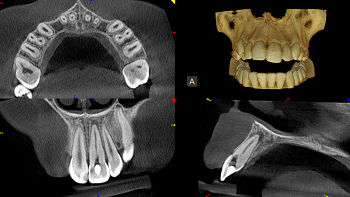 3d_8x5_periodontisis_2_lores-1200wide.png