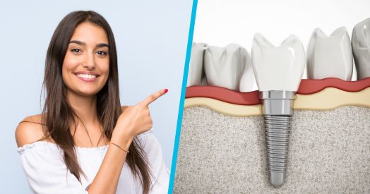 Kāpēc izvēlēties zobu implantus