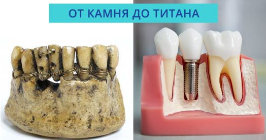 От камня до титана: 6 фактов из истории имплантатов